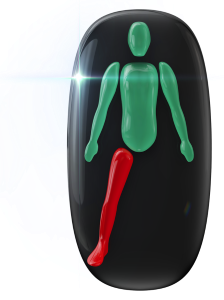 The absence of one leg and the other having movement affected to a high degree.