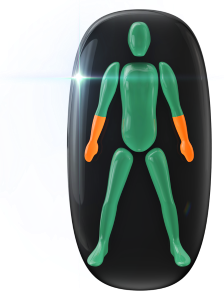 Moderately affected movement in both forearms and hands.