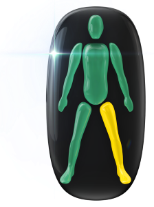 Mildly affected movement in one leg.