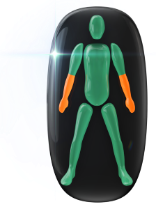 Moderately affected movement and coordination in both forearms.