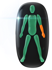 Moderately affected movement and coordination in one forearm.